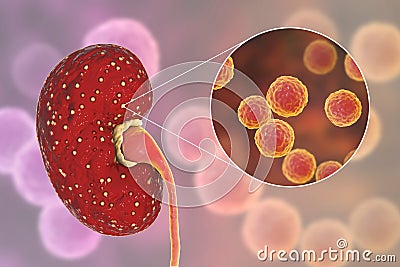 Acute pyelonephritis, medical concept, and close-up view of bacteria Enterococcus Cartoon Illustration