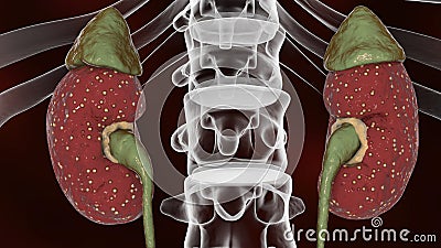 Acute pyelonephritis, medical concept Cartoon Illustration