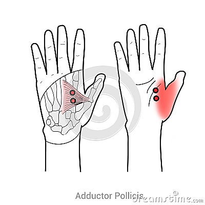 Adductor pollicis: Trigger point thumb pain Cartoon Illustration