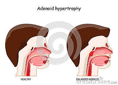 Adenoid hypertrophy Vector Illustration