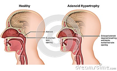 Adenoid hypertrophy medical illustration on white background Cartoon Illustration