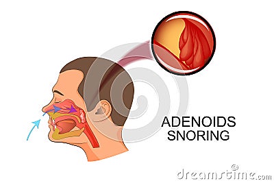 Adenoids cause snoring Vector Illustration