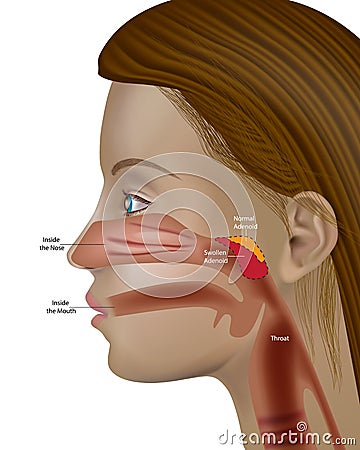 Adenoids, pharyngeal tonsil or nasopharyngeal tonsil Otolaryngology Adenoid hypertrophy Vector Illustration