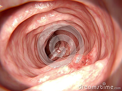 Adenomatous polyp Stock Photo