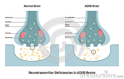 ADHD brain concept. Attention deficit hyperactivity disorder, neurotransmitters Vector Illustration