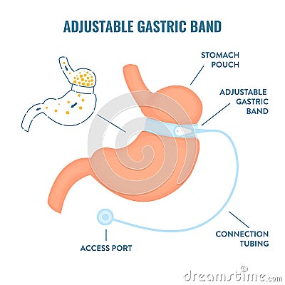 Adjustable gastric band bariatric surgery weight loss infographics Vector Illustration