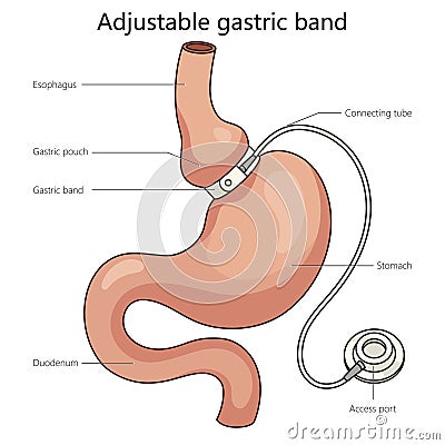 Adjustable gastric band diagram medical science Cartoon Illustration