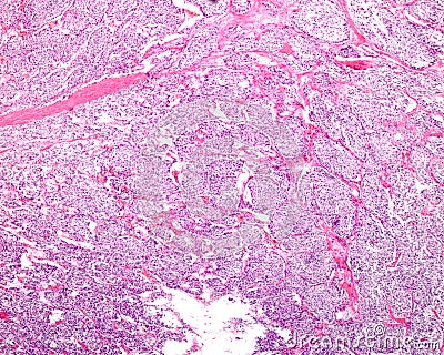 Adrenal cortex carcinoma Stock Photo