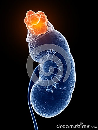 Adrenal gland cancer Cartoon Illustration