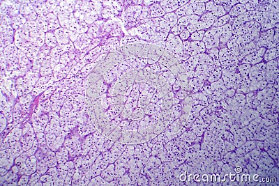 Adrenocortical adenoma, light micrograph Stock Photo