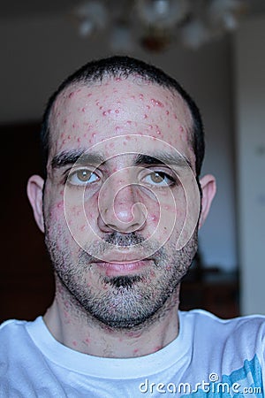 Adult man face with strong aggressive varicella. Varicella or Chicken pox on adult man. Adult man face with varicella. Stock Photo