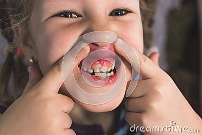 Adult permanent teeth coming in front of the child`s baby teeth: shark teeth Stock Photo