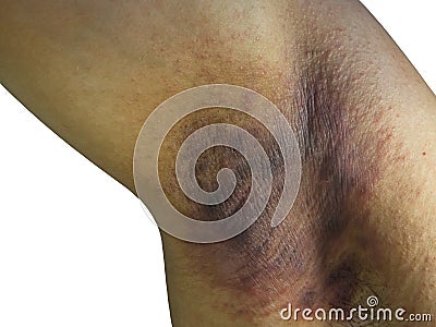 The Affected skin, Armpit Underarm Rash infections ringworm, bacterial folliculitis, hidradenitis suppurativa Stock Photo