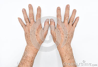 Age spots on hands of Asian elder man. They are brown, gray, or black spots and also called liver spots, senile lentigo, solar Stock Photo