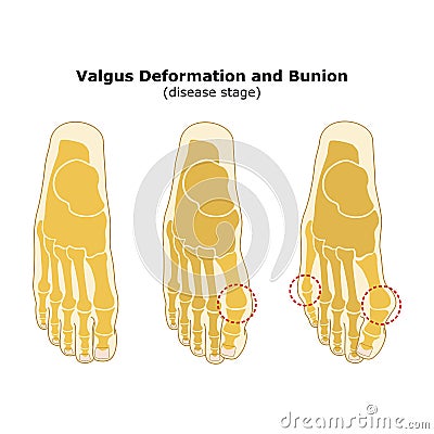 Age and valgus deformity of the thumb. Bunion. Stages of development of the disease. Silhouette of the foot bones. Vector Vector Illustration