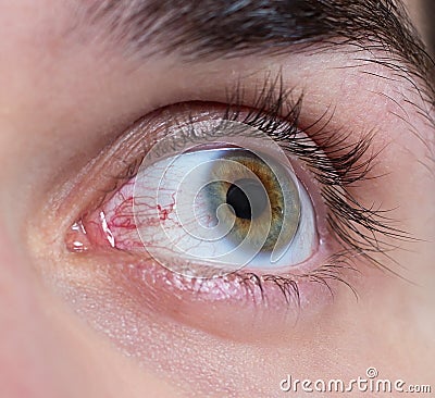 There is reddened the eye of a young guy, a programmer Stock Photo