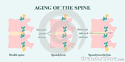 Aging and degeneration of spine columns, patient-friendly diagram Vector Illustration