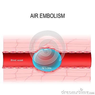 Air embolism is a blood vessel blockage. vector diagram Vector Illustration