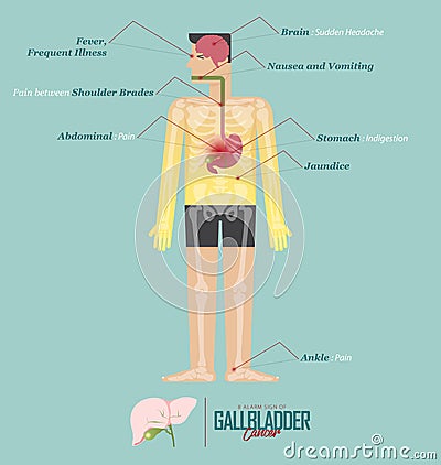 Gallbladder cancer infographic in flat design. Gallbladder cancer disease symptom icon set with human body, skeleton and organ. Vector Illustration