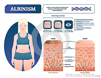 Albinism vector illustration. Labeled medical melanin pigment loss scheme. Vector Illustration