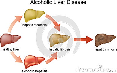 Alcoholic Liver Disease Vector Illustration