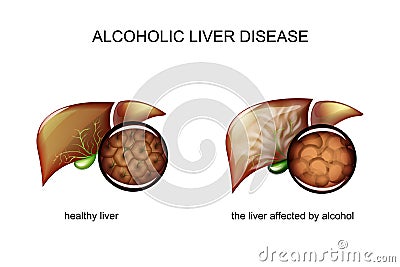 Alcoholic liver disease Vector Illustration