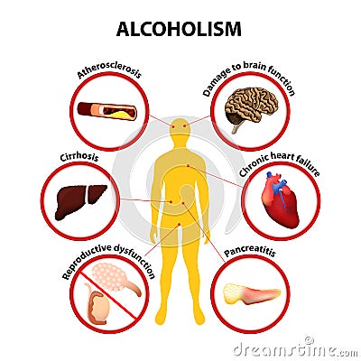 Alcoholism. infographic Vector Illustration