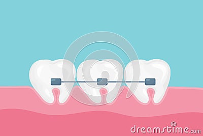 Alignment of teeth and bite correction with the help of braces system. Vector cartoon style. Vector Illustration