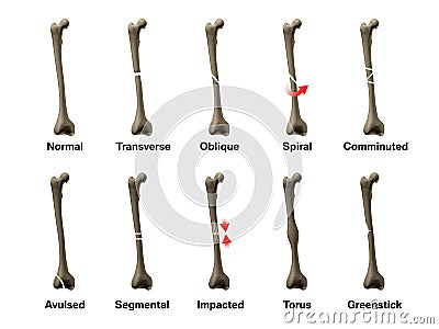 types of bone fracture types of bone fracture
