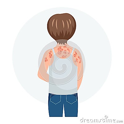Allergic itching, skin inflammation, redness and irritation. A child with allergies. Healthcare and medicine. Vector Illustration
