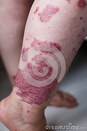Allergic rash dermatitis eczema skin on leg of patient. Psoriasis and eczema skin with big red spots Stock Photo