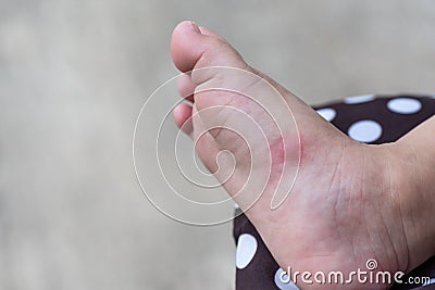 Allergic rash skin of baby`s right foot. Stock Photo