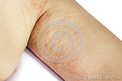 Allergic rash skin of patient arm Stock Photo