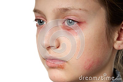 Allergic reaction, skin rash, close view portrait of a girl`s face. Redness and inflammation of the skin in the eyes and lips. Stock Photo