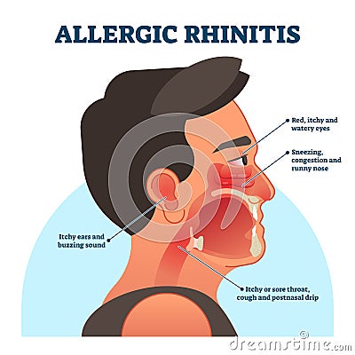 Allergic rhinitis medical diagram, vector illustration labeled information Vector Illustration