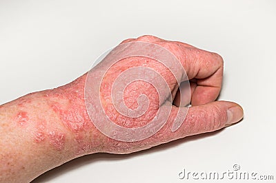 Allergic skin lesions of the hand with cracks, inflammation and flaking. Psoriasis, atopic dermatitis, eczema. Skin problems Stock Photo
