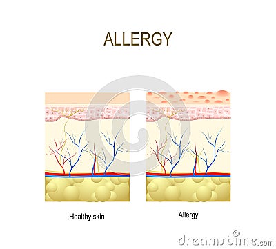 Allergy. healthy and skin with allergic reaction. Vector Illustration