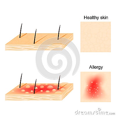 Allergy. healthy skin and allergic reactions. Vector Illustration