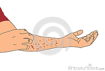Allergy rash red on arm, itching from urticaria or atopic dermatitis, illustration on white background Cartoon Illustration