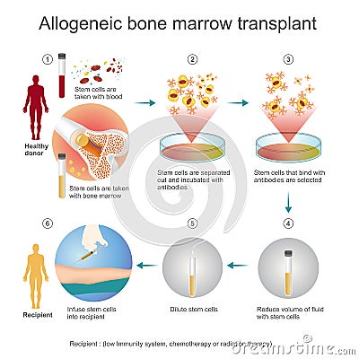 The allogeneic transplant process. Stock Photo