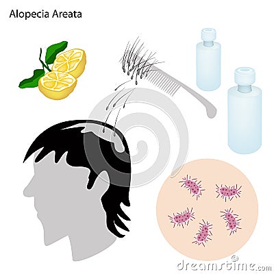 Alopecia Areata with Disease Prevention and Treatment Vector Illustration