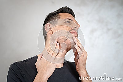 Alopecia areata on a man`s beard Stock Photo