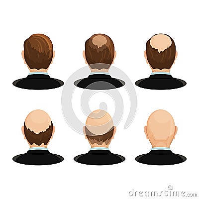 Alopecia concept. Set of heads showing the hairloss progress. Vector Illustration
