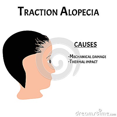 Alopecia hair. Baldness of hair on the head. Traction alopecia causes. Infographics. Vector illustration on isolated Vector Illustration