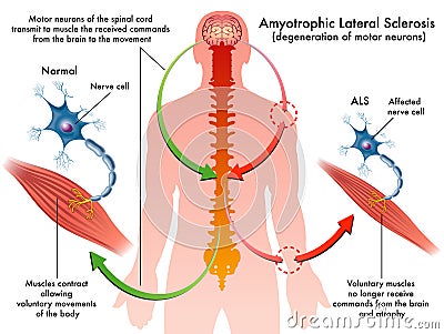 ALS (amyotrophic lateral sclerosis) Vector Illustration