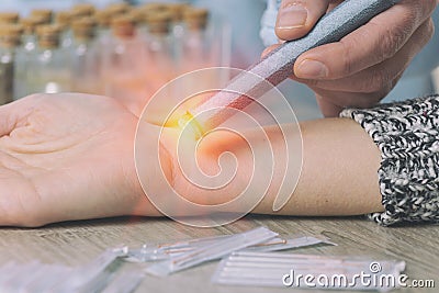 Therapist doing moxa treatment Stock Photo