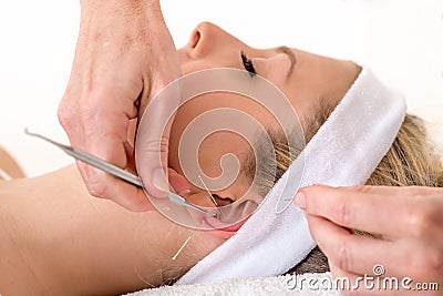 Alternative practitioner treating woman with acupuncture. Stock Photo