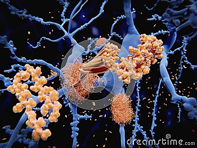 Alzheimer`s disease: the amyloid-beta peptide accumulates to amy Stock Photo