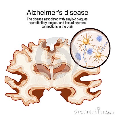 Alzheimer`s disease. Brain and neurons with amyloid plaques Vector Illustration