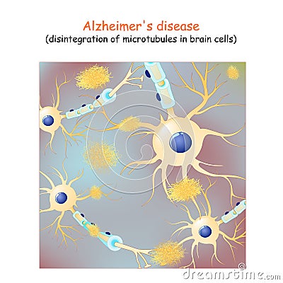 Alzheimer`s disease. dementia. Vector Background with neurons and amyloid plaques Vector Illustration